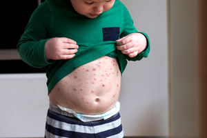 Chickenpox on a child's stomach.