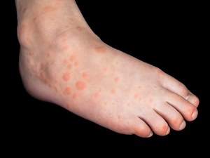 Hand, foot and mouth disease on a child;s foot