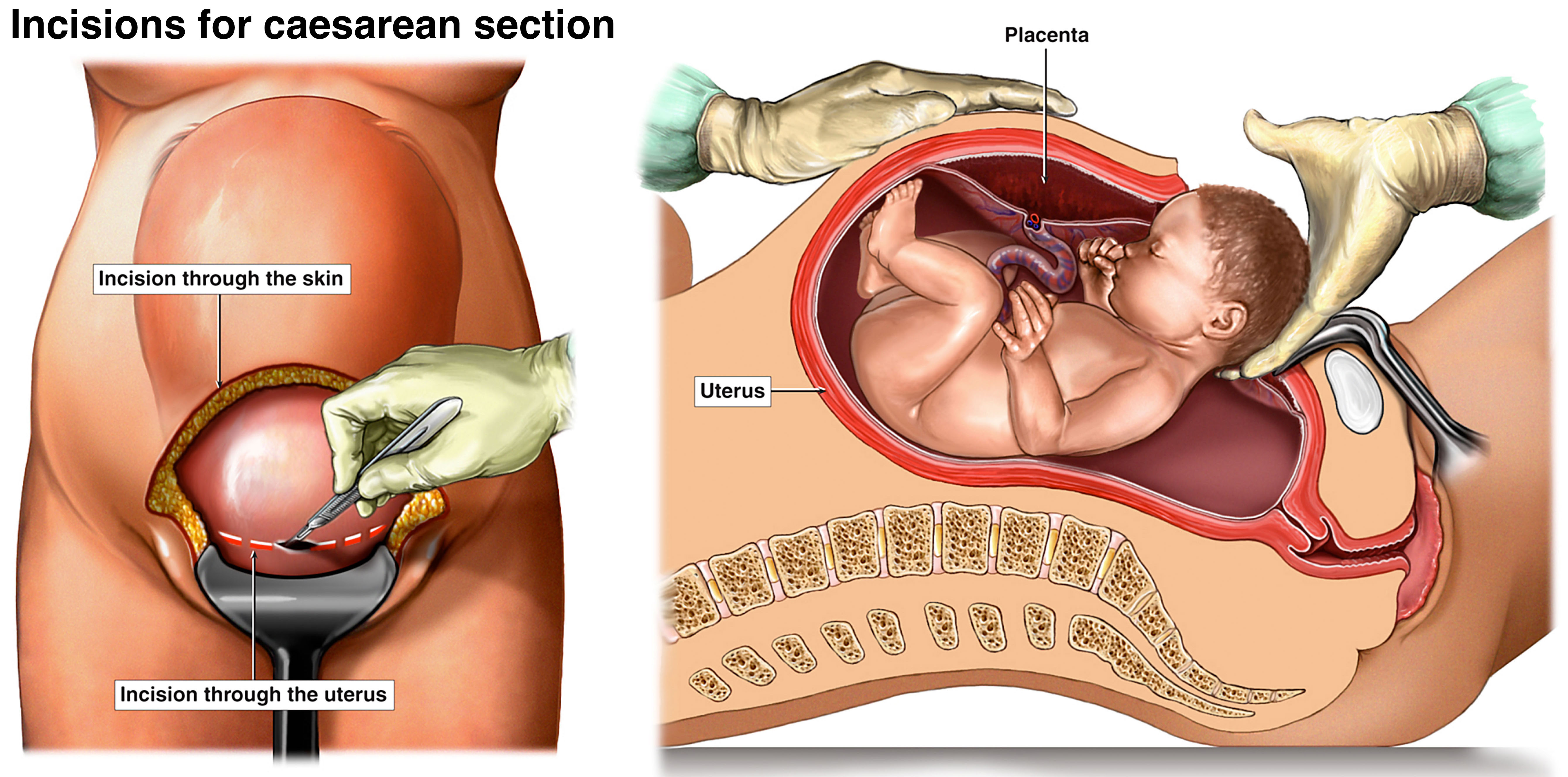 Illustrations showing how a baby is born during a caesarean.