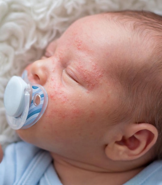 Image of a baby with eczema on their face.