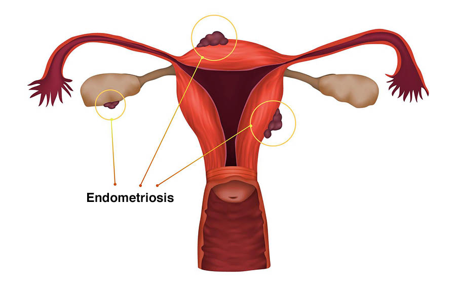 Illustration showing endometriosis occurring outside of the uterus.