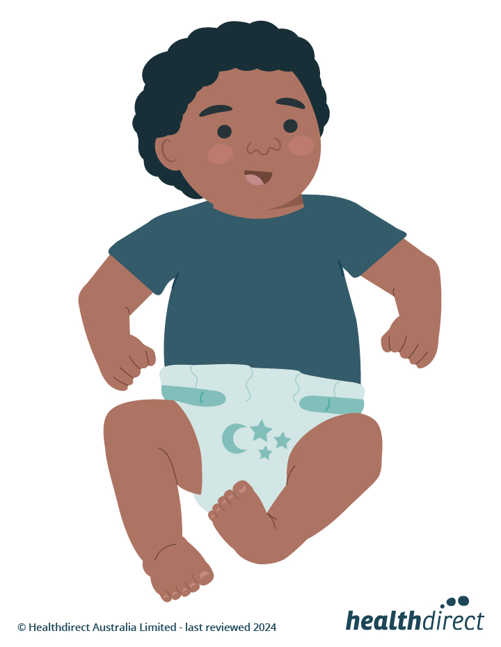 Illustration of a baby with a clubfoot. It shows a foot has turned inwards at the ankle.