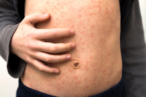 Measles on a stomach