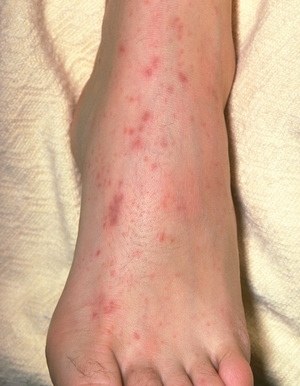 meningococcal on a foot