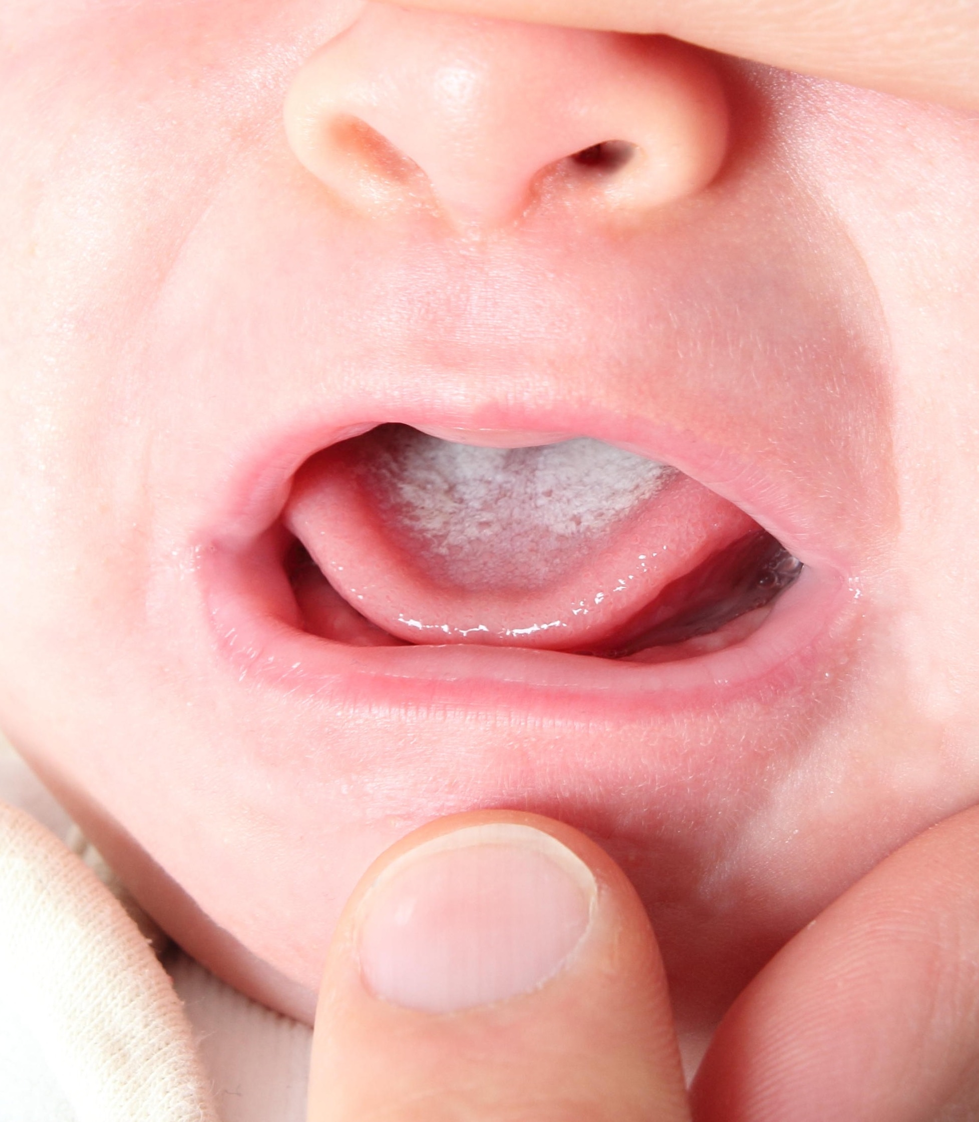 Image of a baby with oral thrush. Their mouth is gently held open, so you can see milky, white patches on the tongue.