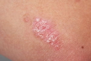 Psoriasis plaques