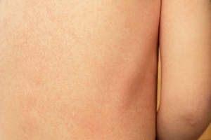 scarlet fever on a child's back