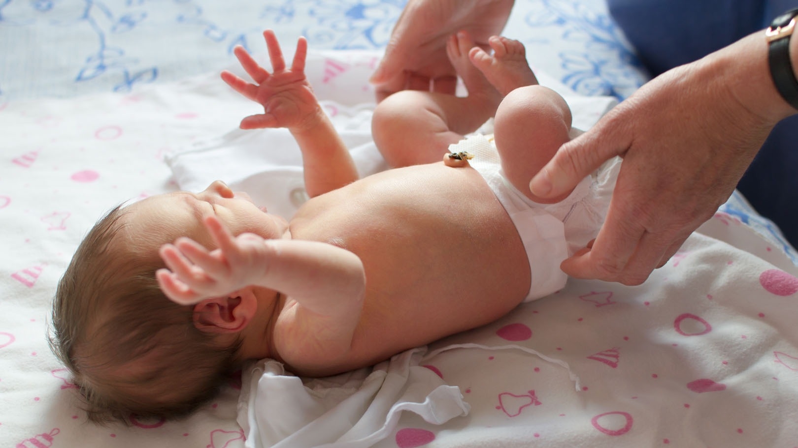 Image of a new born baby with umbilical stump still attached.