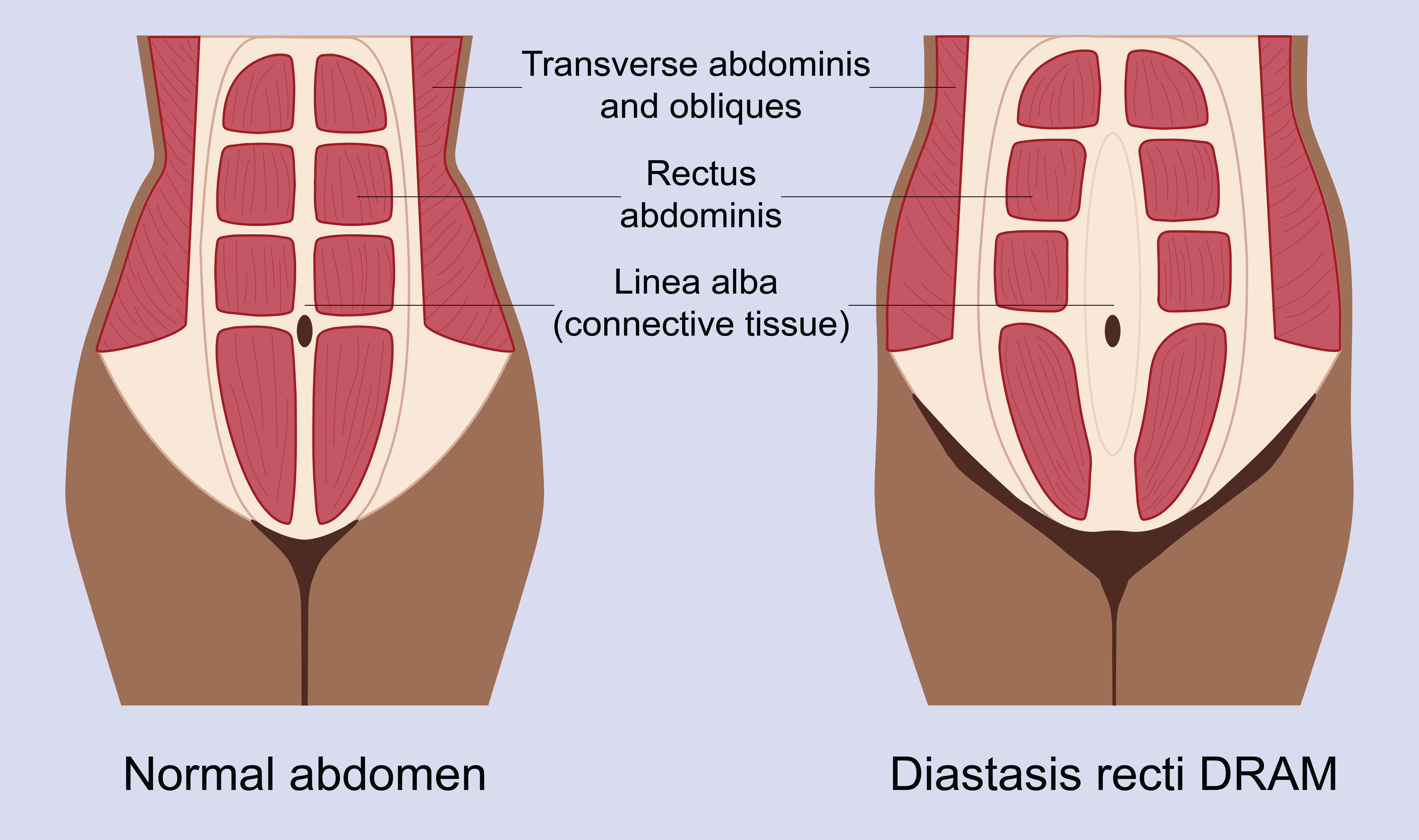 Illustration of a body with normal abdominal muscles and a body with abdominal separation also known as diastasis recti DRAM.