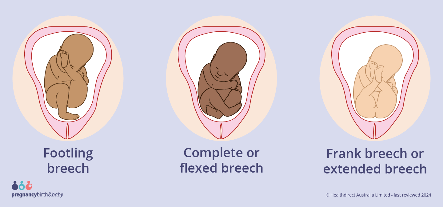 Illustration showing the different types of breech positions