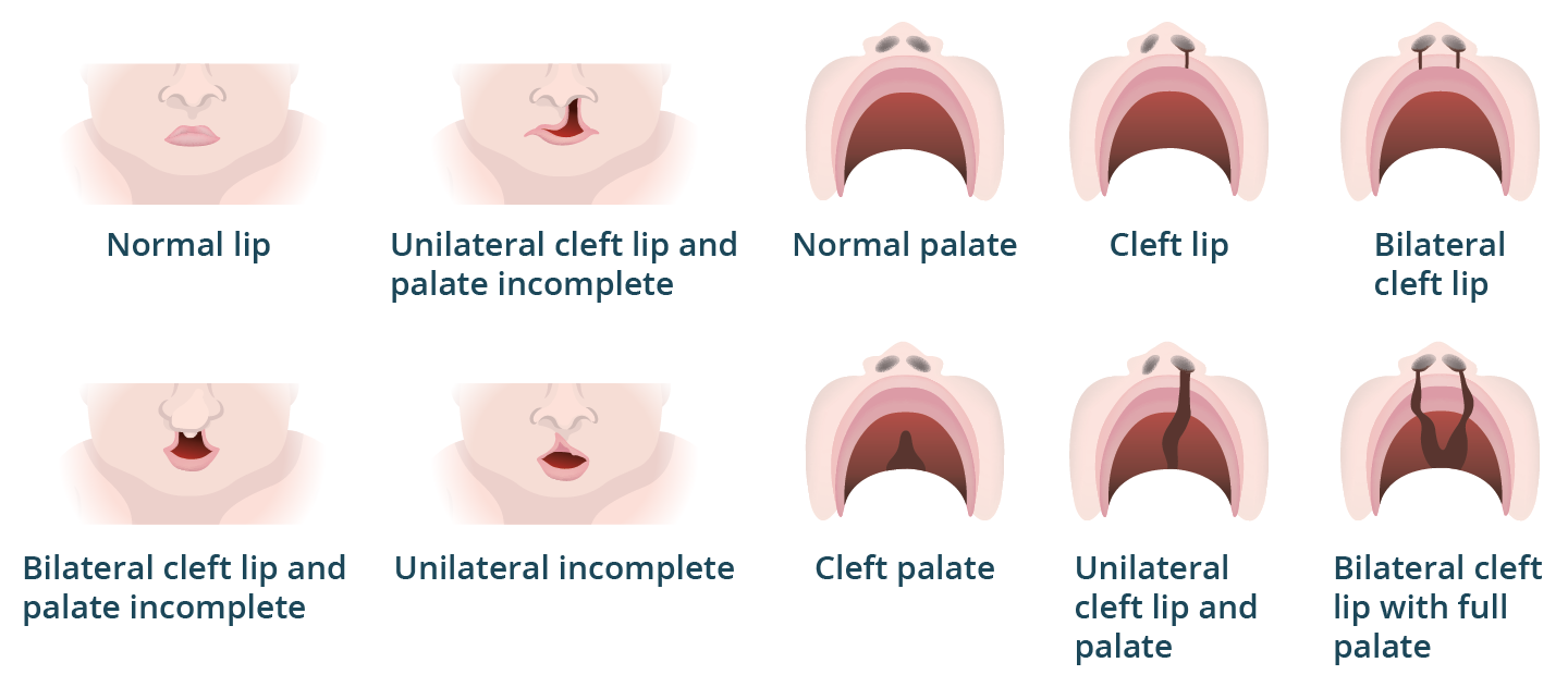 Image showing the various forms of cleft lip and cleft palate in a baby, with views from both the front of the face and inside the mouth.