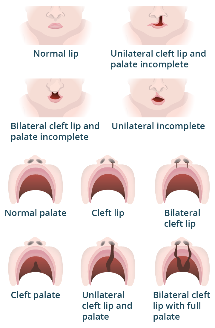 Image showing the various forms of cleft lip and cleft palate in a baby, with views from both the front of the face and inside the mouth.