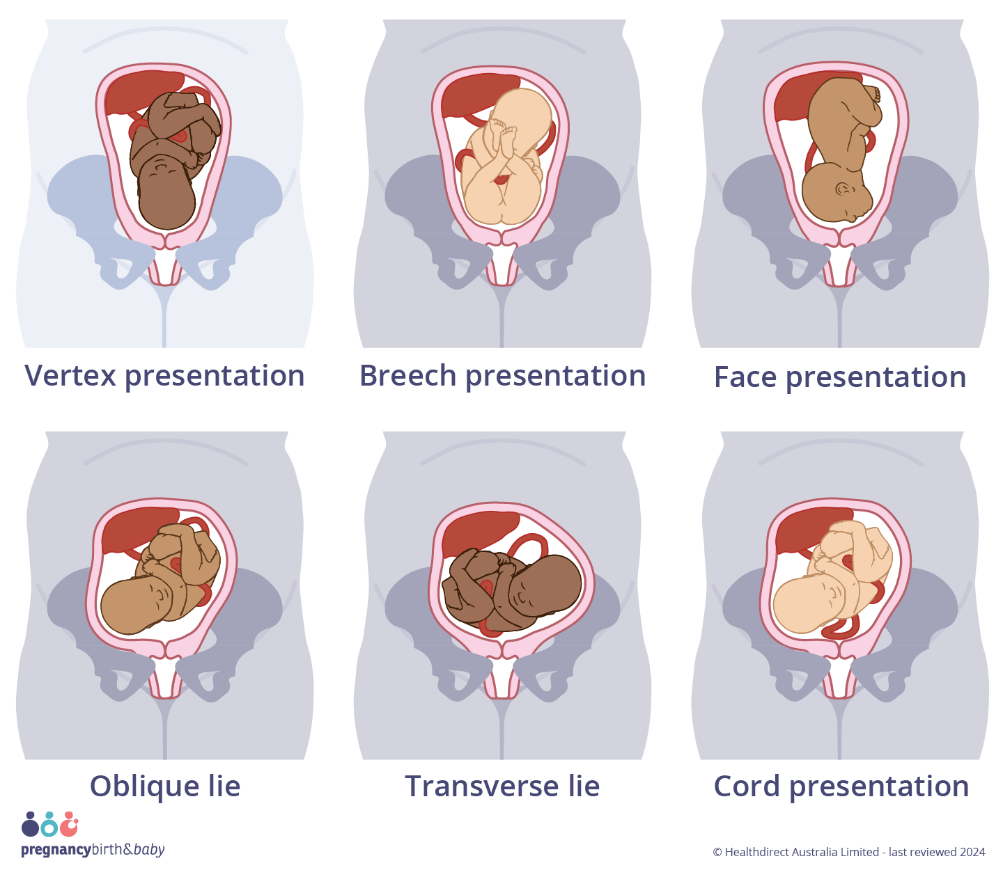 Illustration of ideal presentation (vertex presentation, head-first) and malpresentations; Breech, face, transverse, oblique lie and cord presentation.