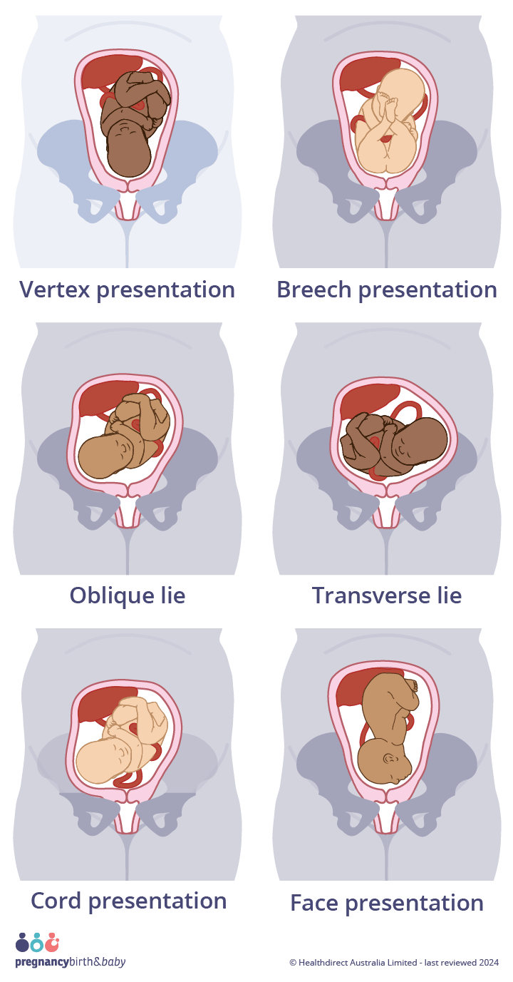 Illustration of ideal presentation (vertex presentation, head-first) and malpresentations; Breech, face, transverse, oblique lie and cord presentation.