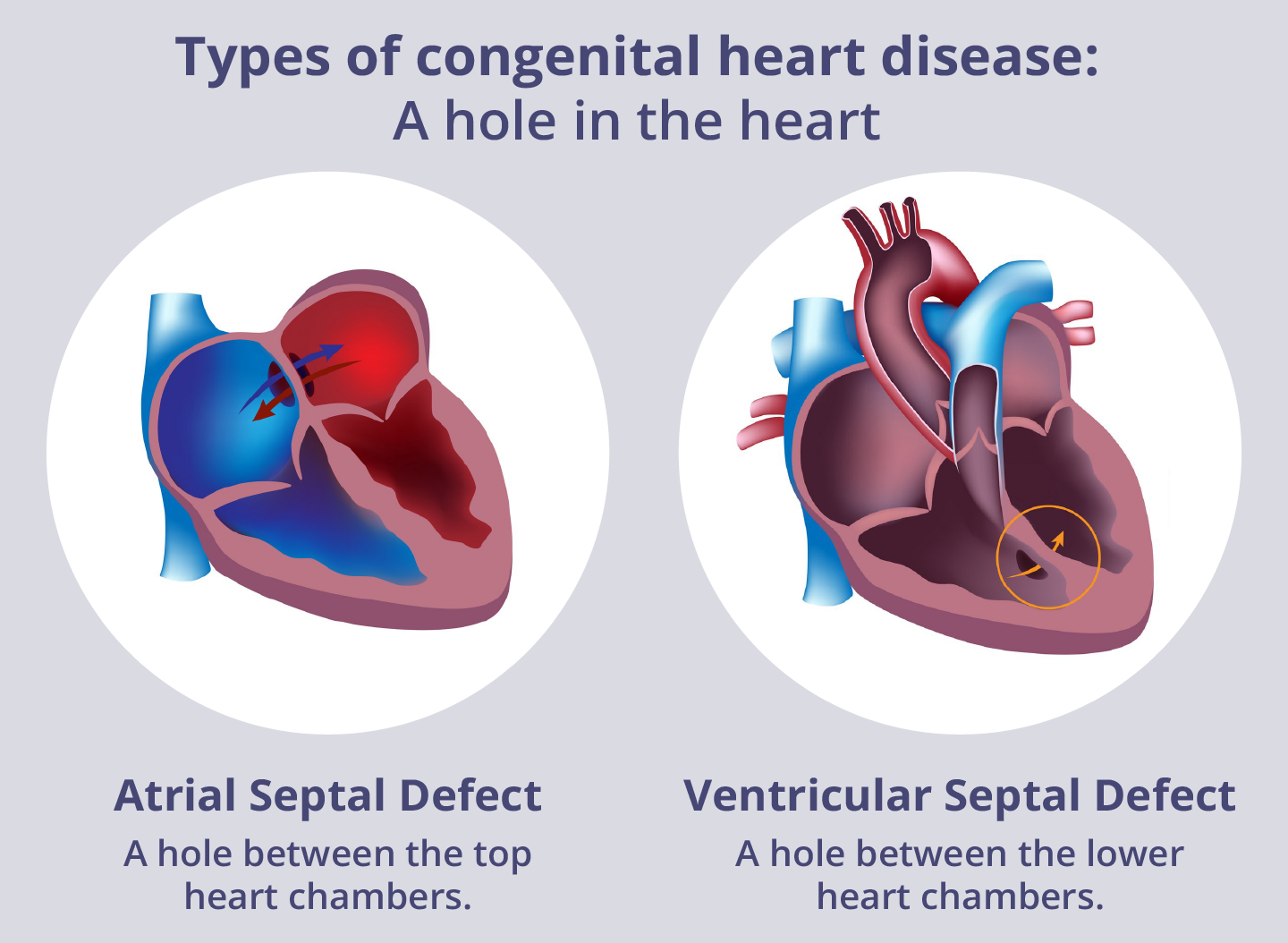 Examples of a hole in the heart. Image on the left shows an atrial septal defect: a hole between the top heart chambers. Image on the right shows a ventricular septal defect: a hole between the lower heart chambers.