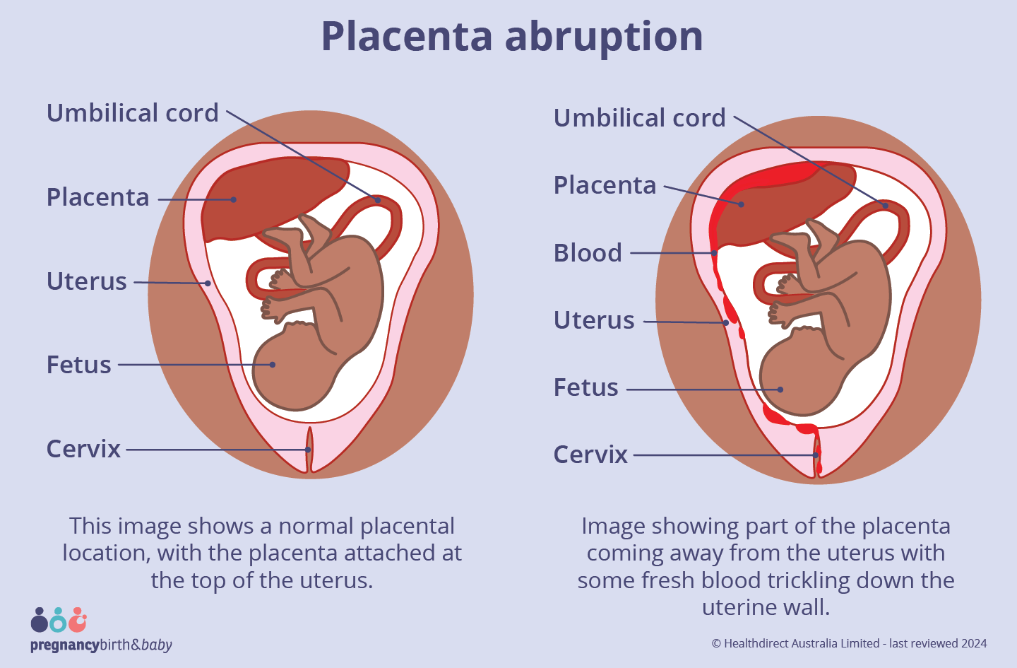 Image showing placenta abruption, where part of the placenta has come away from the uterus and some fresh blood trickling down the uterine wall