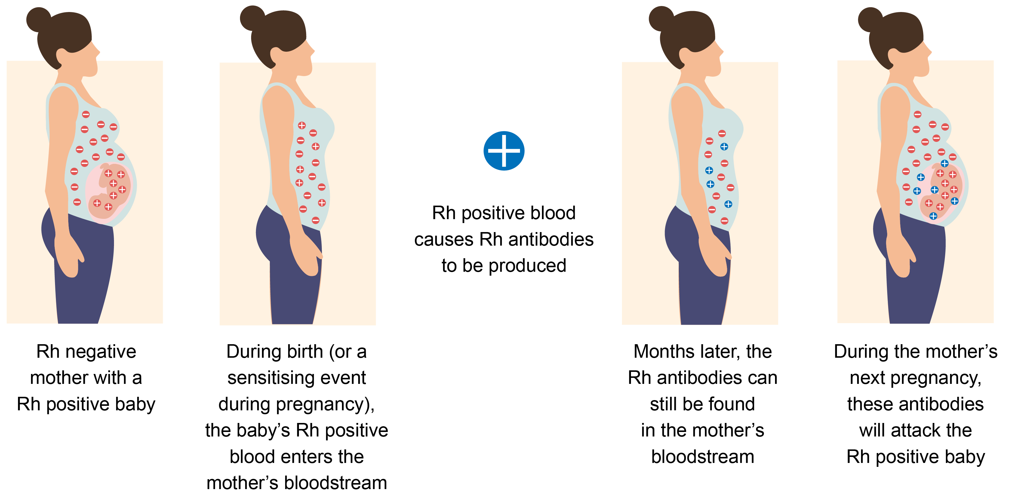 Illustration showing how haemolytic disease of the newborn can occur.