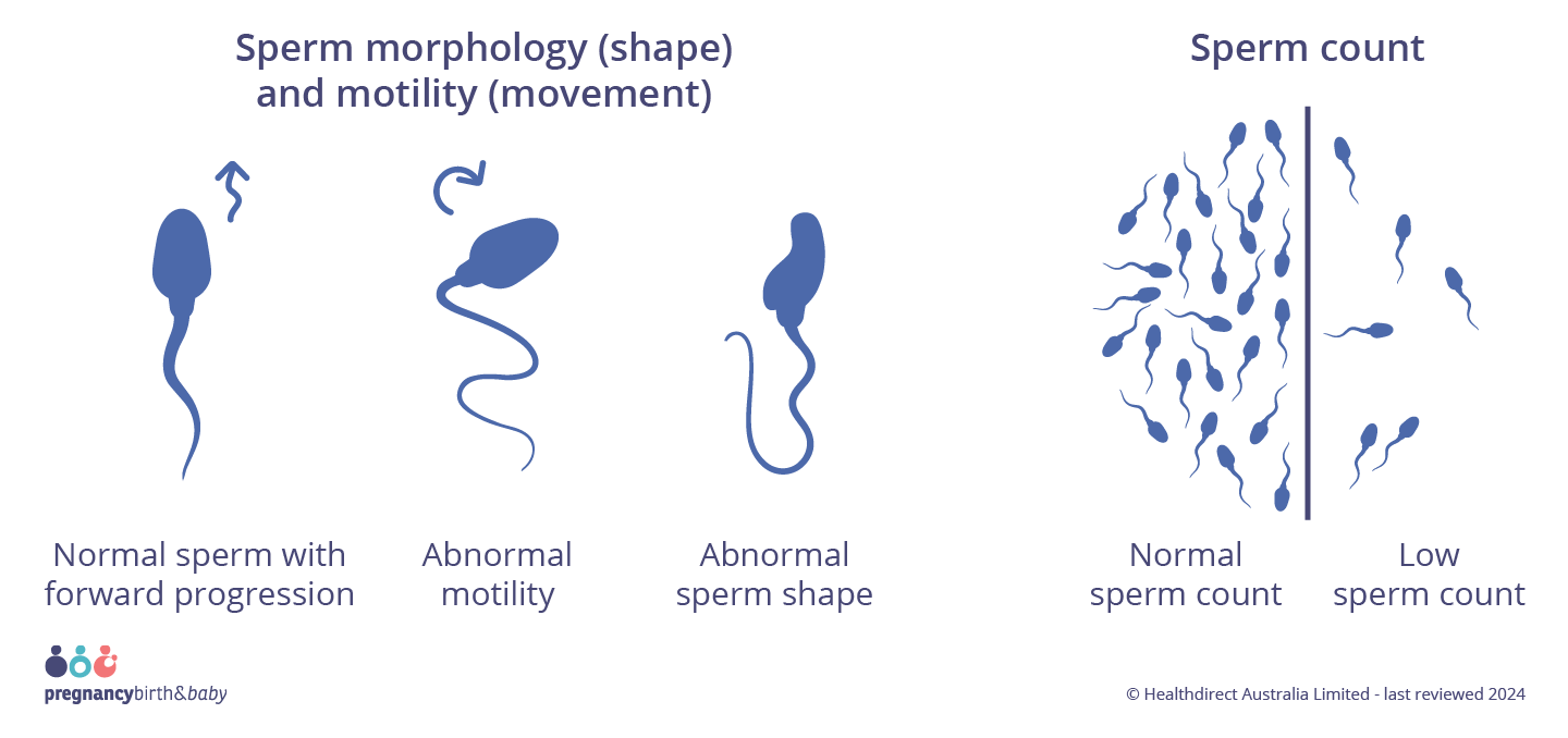 Infographic on sperm health, showing examples of normal sperm movement (forward spiraling like a cork screw) and abnormal movement (zig zagging or circling in on itself), normal sperm shape (oval head with a long tail) and an abnormal shape (head or tail defects). Along with a side by side comparison of normal sperm count (at least 15million sperm per mL) and low sperm count.