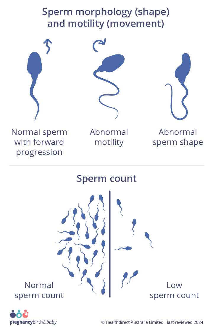 Infographic on sperm health, showing examples of normal sperm movement (forward spiraling like a cork screw) and abnormal movement (zig zagging or circling in on itself), normal sperm shape (oval head with a long tail) and an abnormal shape (head or tail defects). Along with a side by side comparison of normal sperm count (at least 15million sperm per mL) and low sperm count.